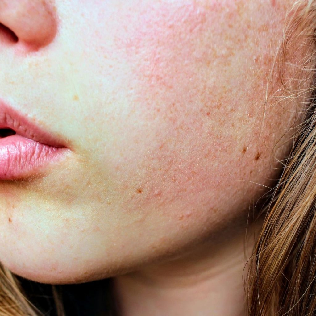 5 common causes of Dry Skin